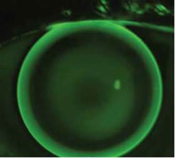 Contact Lenses that were fitted for patients with degenerative disease of the cornea called Keratoconus